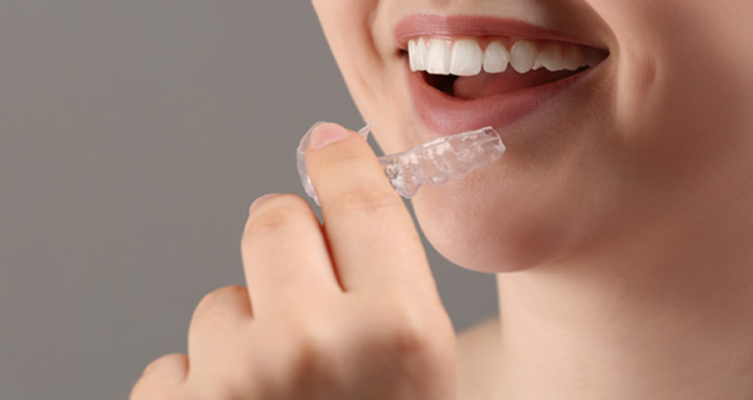 Máng chống nghiến: Giải pháp bảo vệ răng hiệu quả