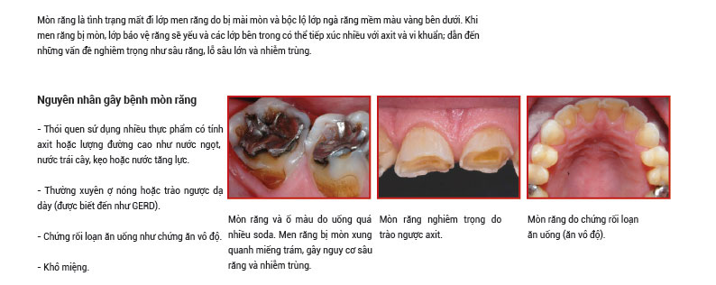 Mòn răng: Nguyên nhân, hậu quả và giải pháp phòng ngừa