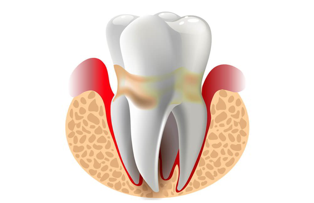 Nang thân răng: 5 biểu hiện và phương pháp điều trị hiệu quả