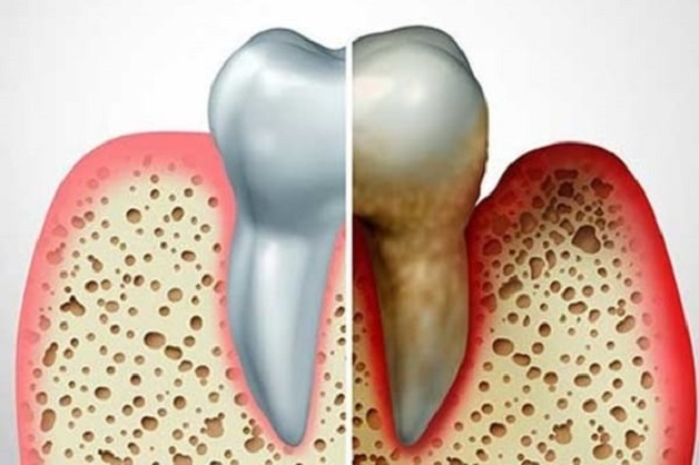 Nang thân răng: 5 biểu hiện và phương pháp điều trị hiệu quả
