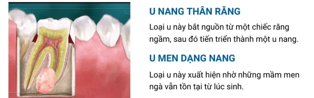 Nang thân răng: 5 biểu hiện và phương pháp điều trị hiệu quả