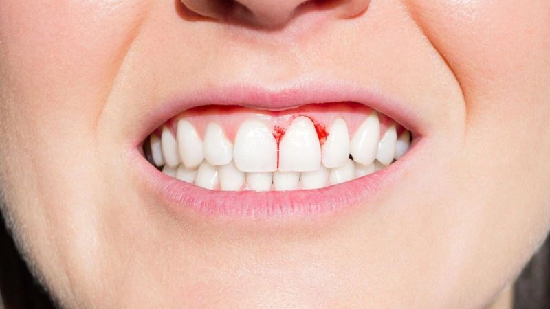 Đau nướu: Nguyên nhân và cách khắc phục hiệu quả
