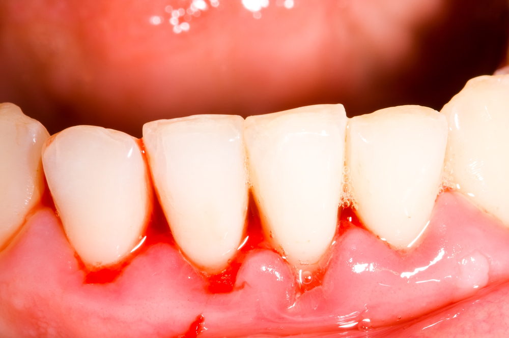 Đau nướu: Nguyên nhân và cách khắc phục hiệu quả