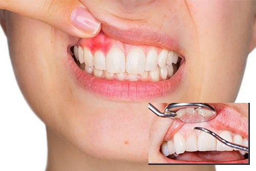 Đau nướu: Nguyên nhân và cách khắc phục hiệu quả