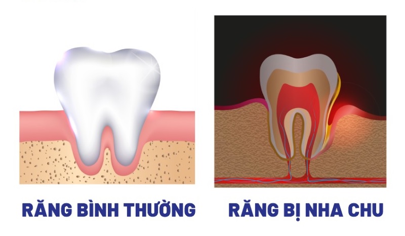 Đau nướu: Nguyên nhân và cách khắc phục hiệu quả