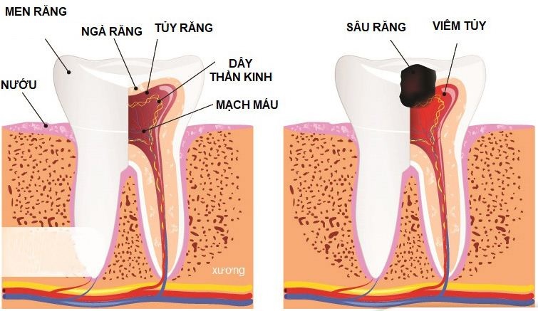 Viêm quanh cuống răng: 5 dấu hiệu và cách điều trị hiệu quả