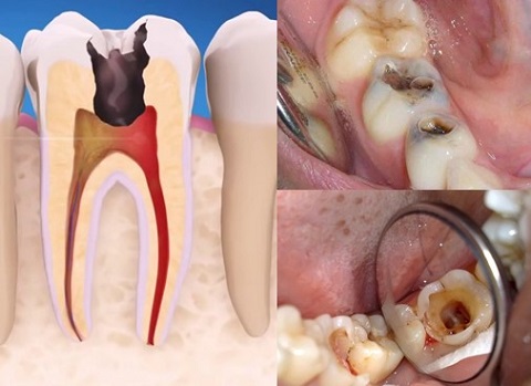Viêm quanh cuống răng: 5 dấu hiệu và cách điều trị hiệu quả