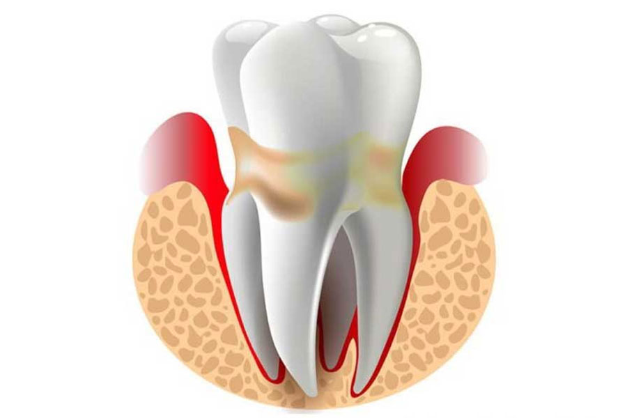 Viêm quanh cuống răng: 5 dấu hiệu và cách điều trị hiệu quả