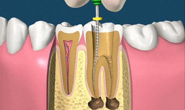 Viêm quanh cuống răng: 5 dấu hiệu và cách điều trị hiệu quả
