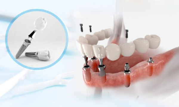 Viêm quanh implant: 4 phương án điều trị an toàn hiệu quả nhất