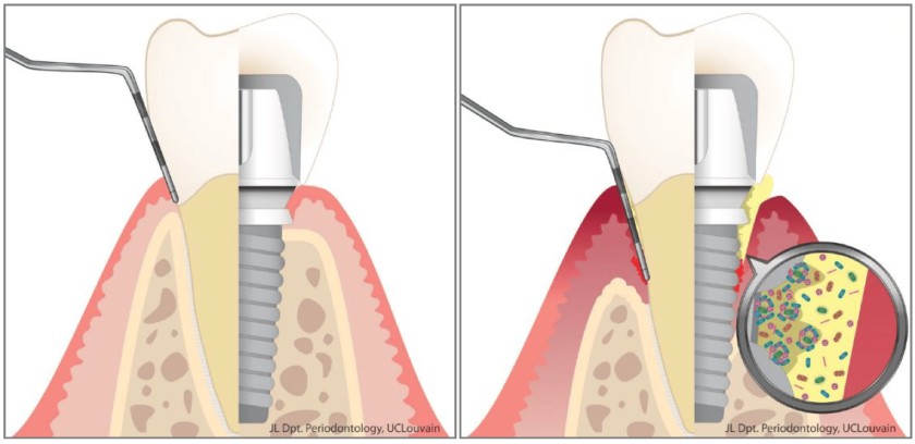 Viêm quanh implant: 4 phương án điều trị an toàn hiệu quả nhất