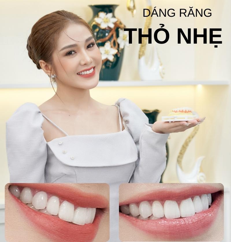 Dáng Răng Thỏ: Xu Hướng Thẩm Mỹ Nụ Cười Đáng Yêu