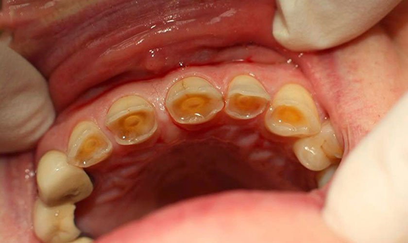 Mòn Răng: Nguyên Nhân Và 5 Cách Khắc Phục Hiệu Quả