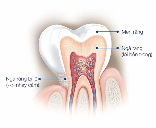 Mòn răng: Nguyên nhân và 5 cách khắc phục hiệu quả