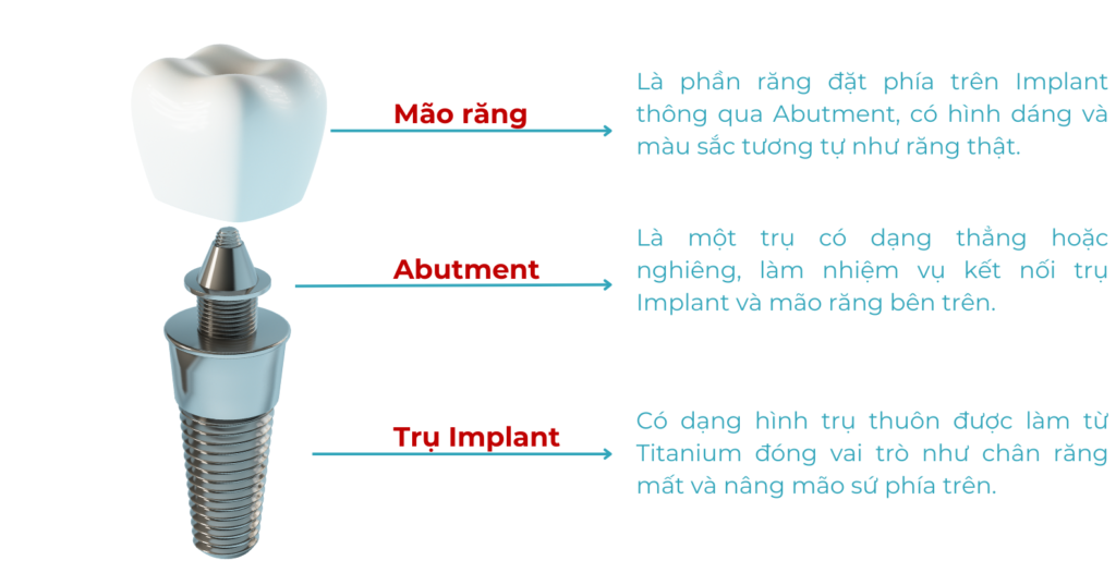 Các loại răng trên implant: Phân loại và lựa chọn phù hợp