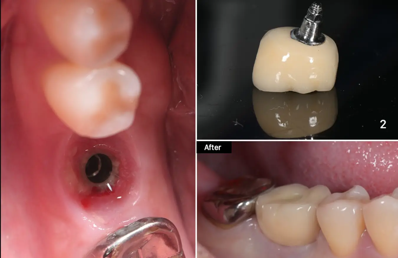 Các loại răng trên implant: Phân loại và lựa chọn phù hợp