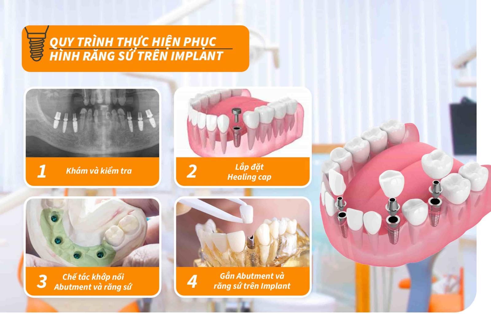 Các loại răng trên implant: Phân loại và lựa chọn phù hợp