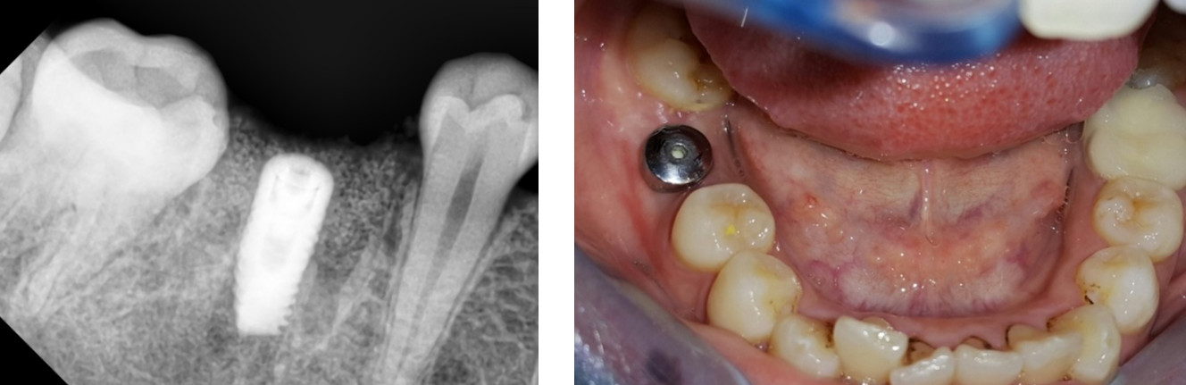 Cấy ghép implant tức thì và 5 điều cần biết trước khi thực hiện
