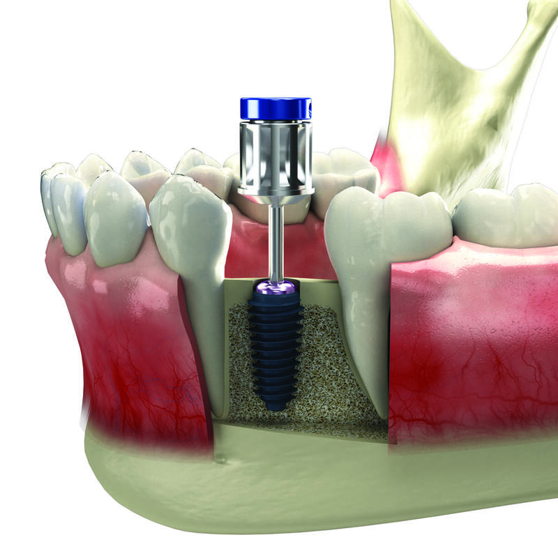 Cấy ghép implant tức thì và 5 điều cần biết trước khi thực hiện