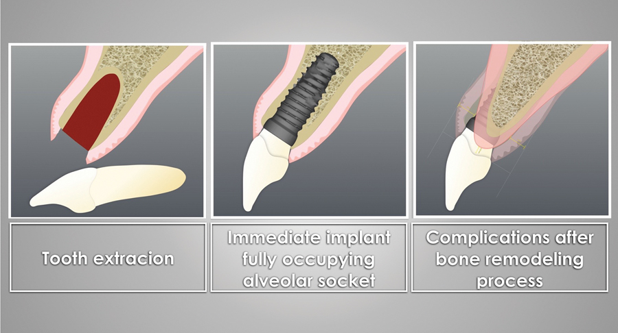 Cấy ghép implant tức thì và 5 điều cần biết trước khi thực hiện