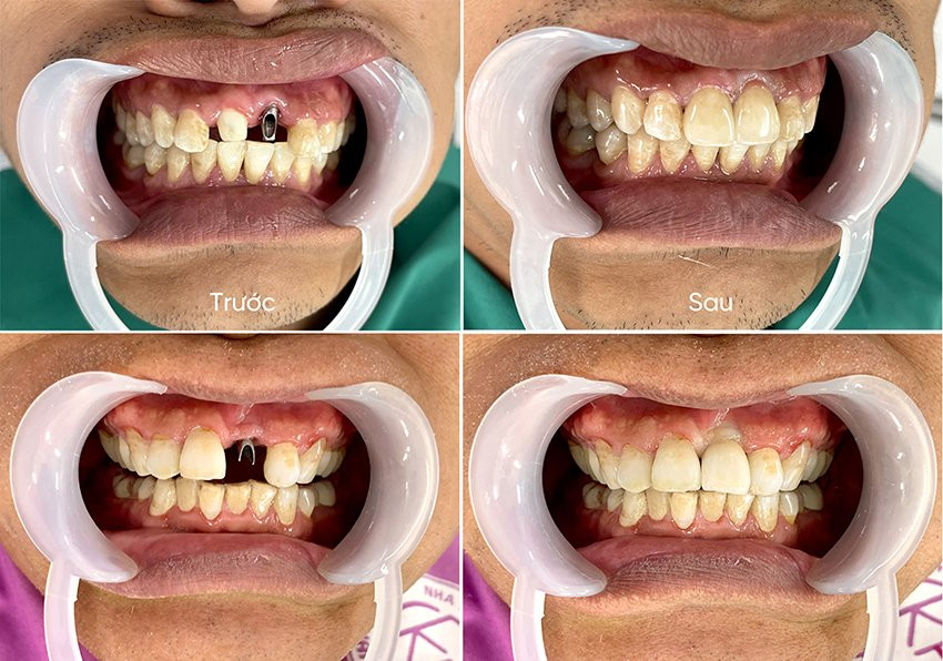 Cấy ghép implant tức thì và 5 điều cần biết trước khi thực hiện