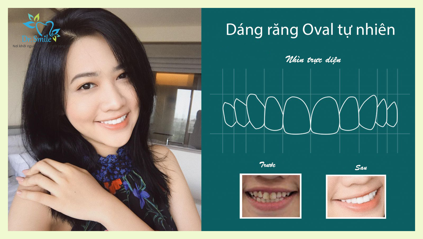 Dáng răng oval là gì? Lựa chọn hoàn hảo cho vẻ đẹp dịu dàng