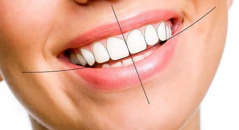 Dáng răng oval là gì? Lựa chọn hoàn hảo cho vẻ đẹp dịu dàng