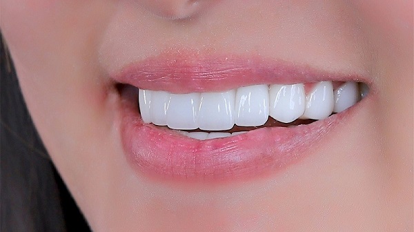 Dáng răng oval là gì? Lựa chọn hoàn hảo cho vẻ đẹp dịu dàng