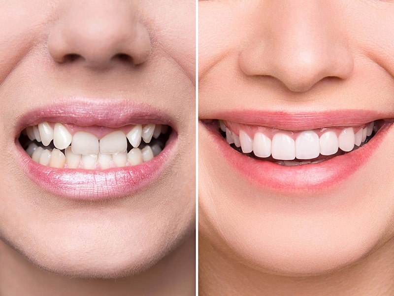 Dáng răng vuông là gì? Có phù hợp với phong cách thẩm mỹ của bạn?