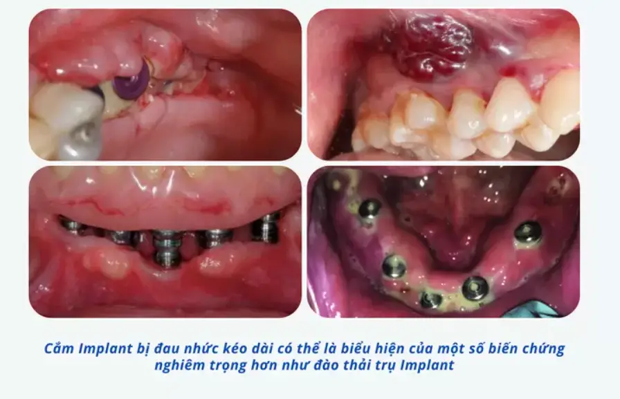 Implant bị đào thải: Nguyên nhân và cách khắc phục hiệu quả