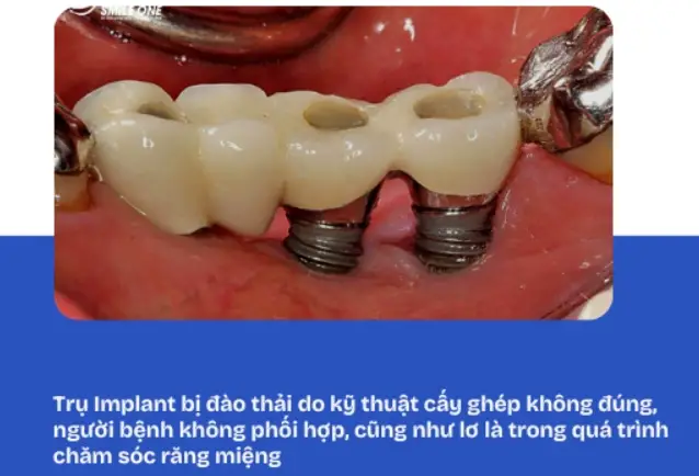 Implant bị đào thải: Nguyên nhân và cách khắc phục hiệu quả