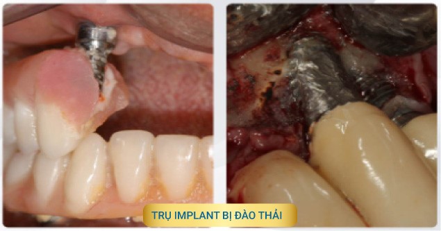Implant bị đào thải: Nguyên nhân và cách khắc phục hiệu quả