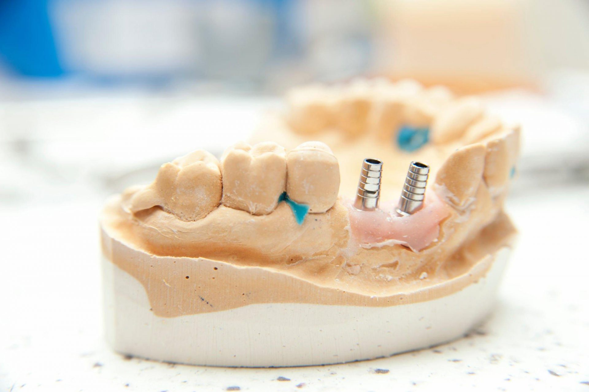 Implant bị đào thải: Nguyên nhân và cách khắc phục hiệu quả