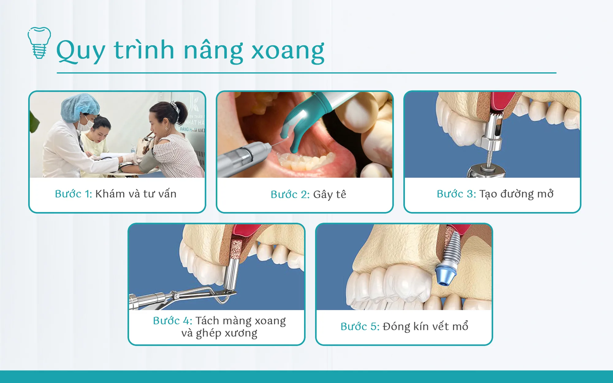 Nâng xoang ghép xương và 6 điều bạn cần biết trước khi thực hiện