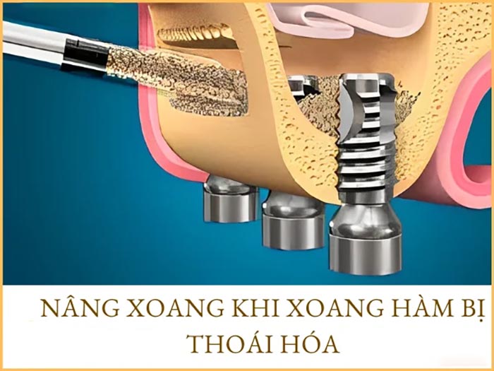 Nâng xoang ghép xương và 6 điều bạn cần biết trước khi thực hiện