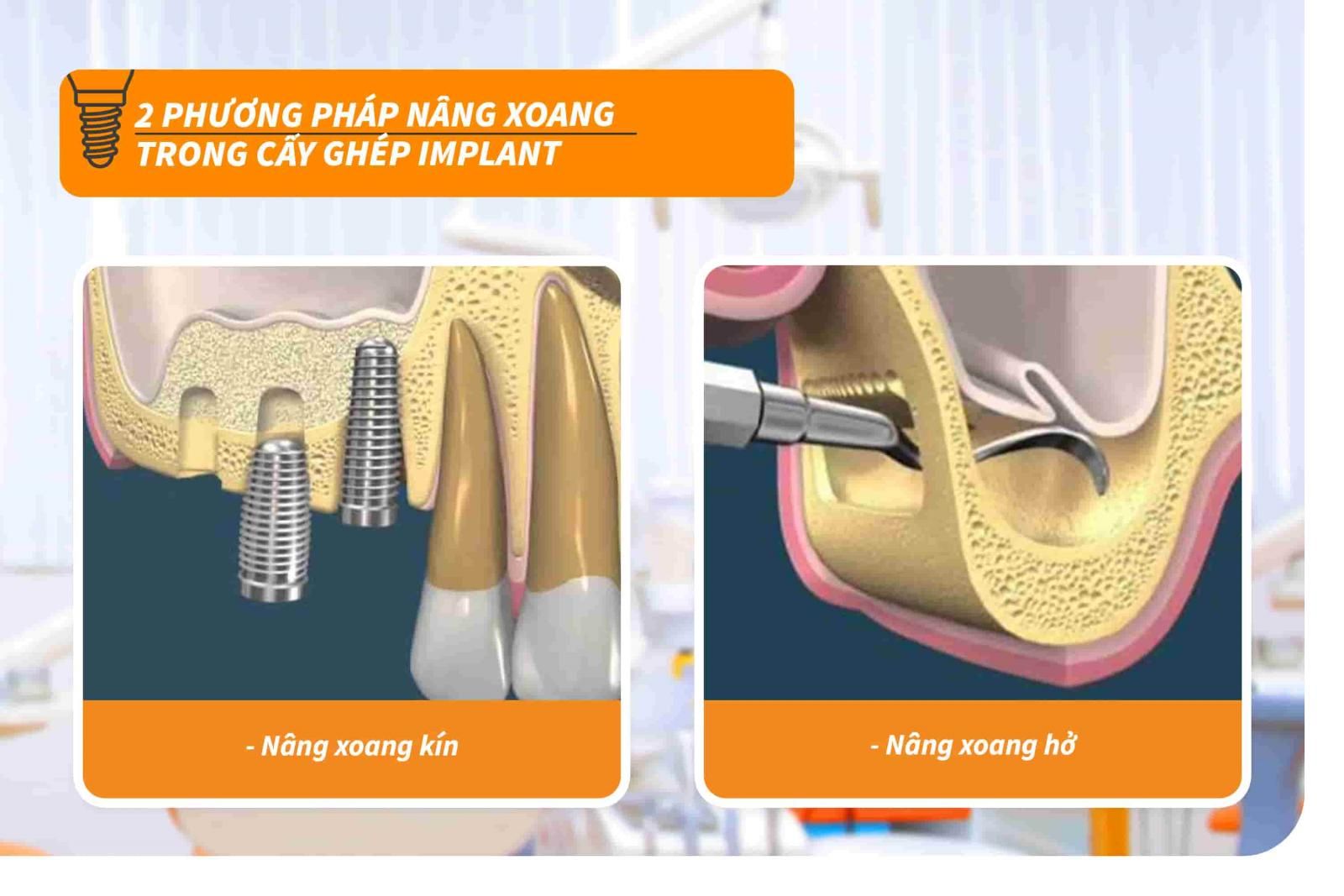 Nâng xoang ghép xương và 6 điều bạn cần biết trước khi thực hiện