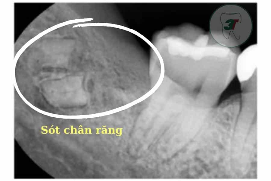 Nhổ chân răng: Quy trình chuẩn và 5 lưu ý quan trọng