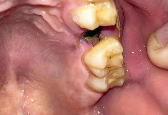 Nhổ chân răng: Quy trình chuẩn và 5 lưu ý quan trọng
