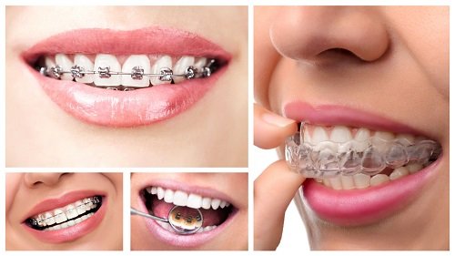 Nhổ răng khi niềng răng: 5 điều bạn cần biết trước khi thực hiện