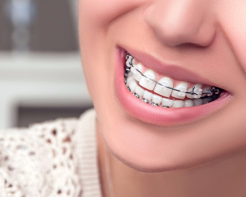 Nhổ răng khi niềng răng: 5 điều bạn cần biết trước khi thực hiện