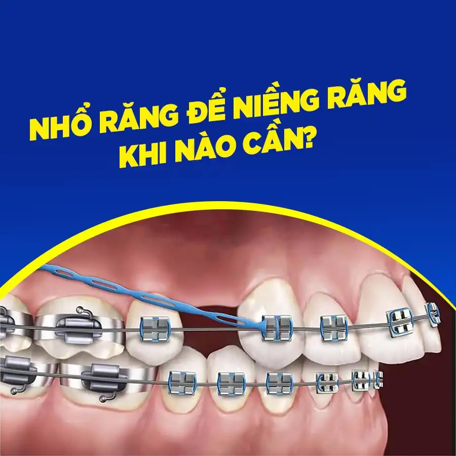 Nhổ răng khi niềng răng: 5 điều bạn cần biết trước khi thực hiện