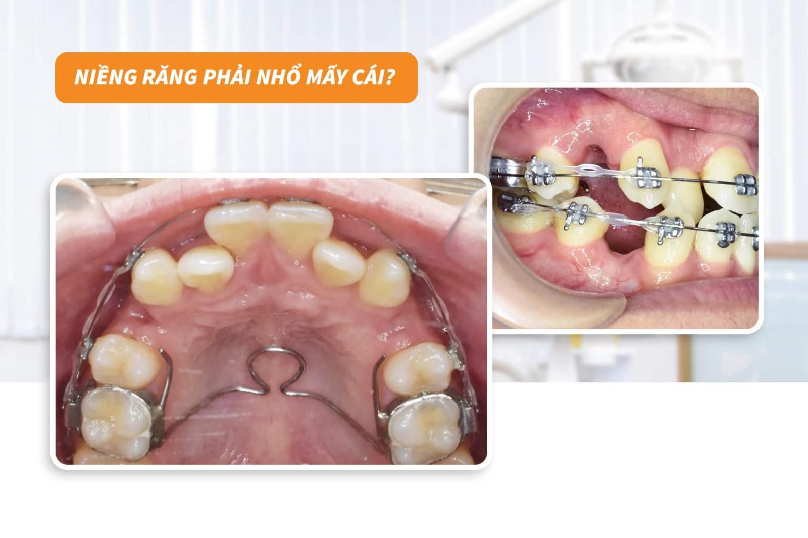 Nhổ răng khi niềng răng: 5 điều bạn cần biết trước khi thực hiện