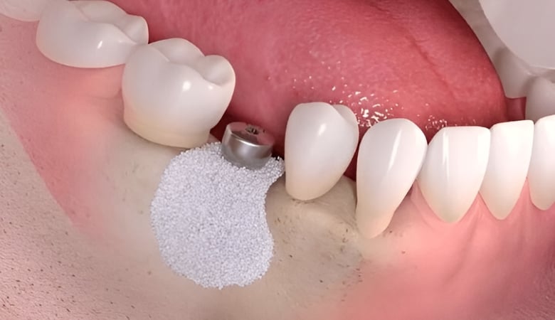 Thời điểm cắm implant: Khi nào là tốt nhất để phục hình răng?