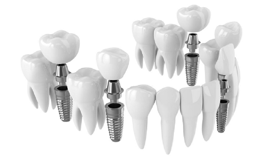 Thời điểm cắm implant: Khi nào là tốt nhất để phục hình răng?