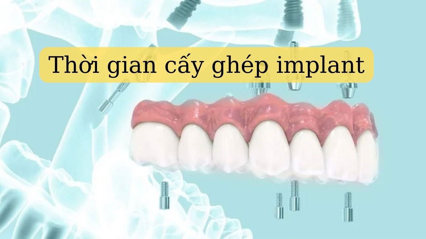 Thời điểm cắm implant: Khi nào là tốt nhất để phục hình răng?