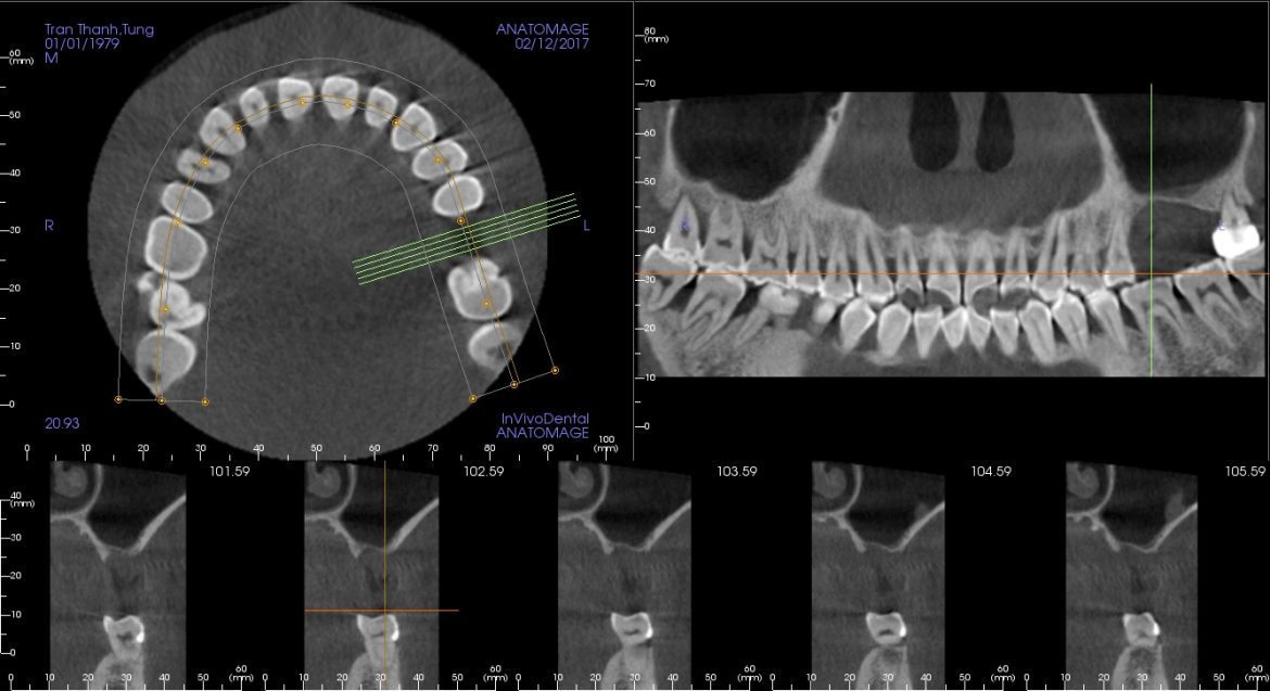 Thời điểm cắm implant: Khi nào là tốt nhất để phục hình răng?