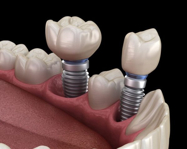 Thời điểm cắm implant: Khi nào là tốt nhất để phục hình răng?