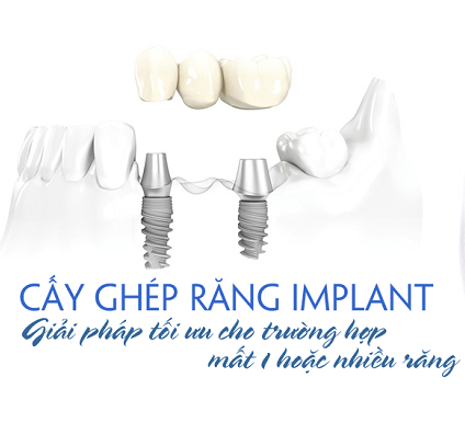 Thời điểm cắm implant: Khi nào là tốt nhất để phục hình răng?