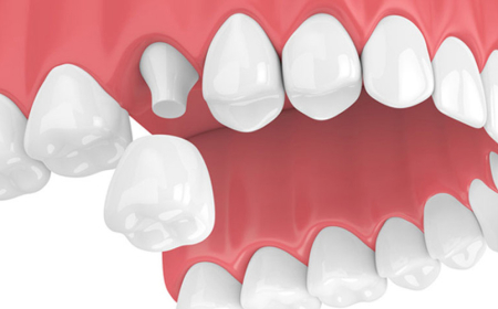 Bọc răng sứ răng số 7: Cách chọn lựa và quy trình thực hiện hiệu quả