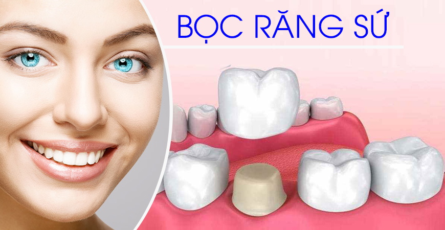 Bọc răng sứ răng số 7: Cách chọn lựa và quy trình thực hiện hiệu quả